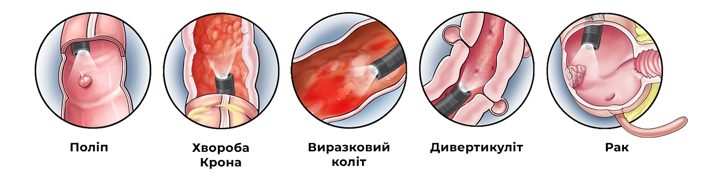 Захворювання, які діагностує колоноскопія