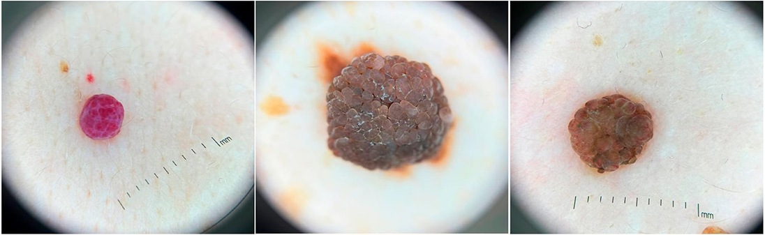 дерматоскопия