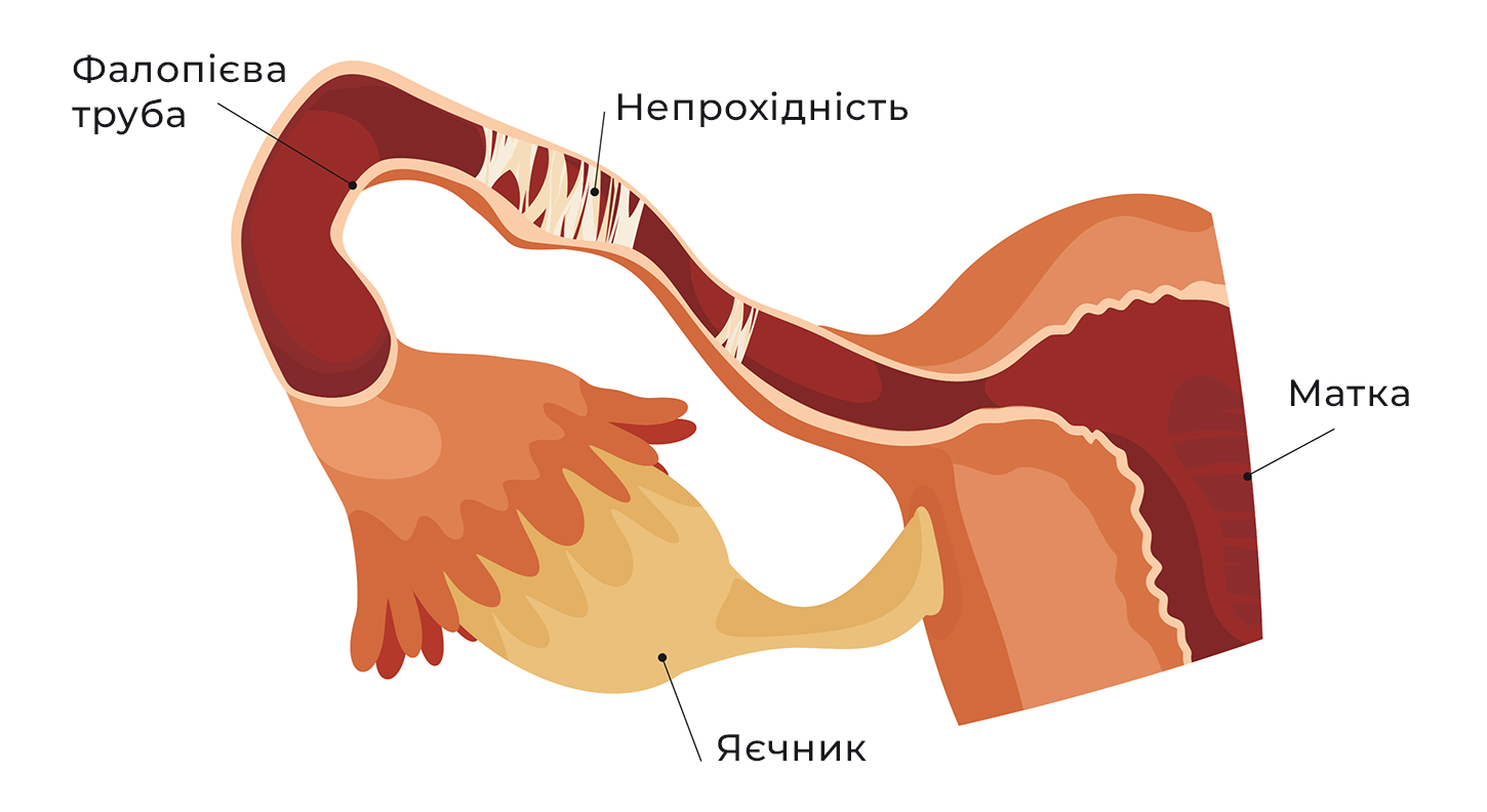 Непрохідність маткових труб