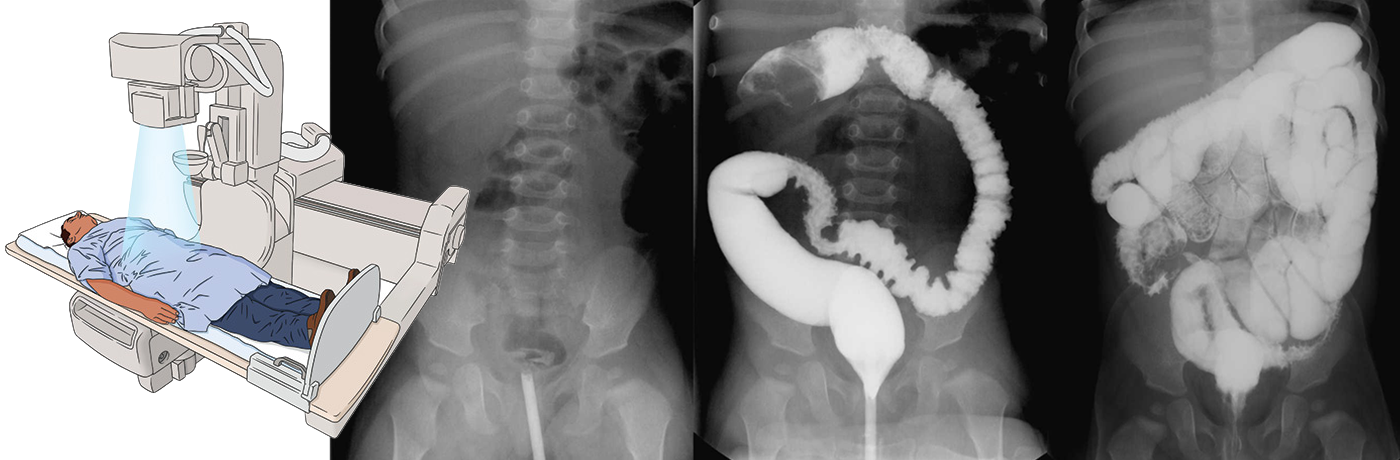 Іригоскопія. Рентген кишечника з барієм