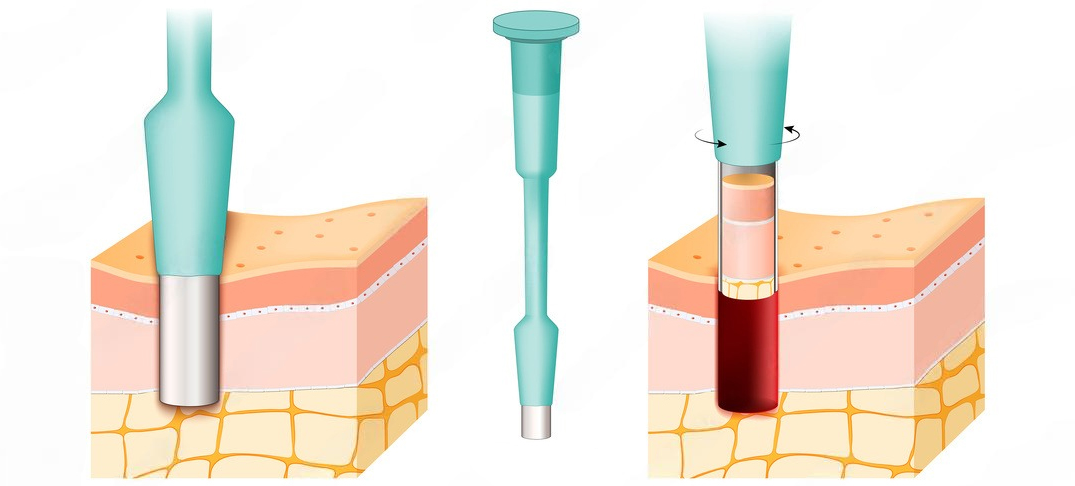 Ексцизійна біопсія шкіри