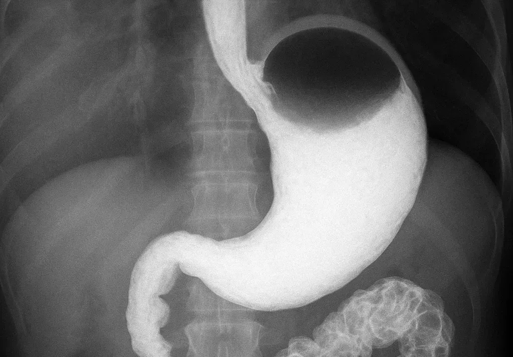 Рентгеноскопія шлунка та стравоходу
