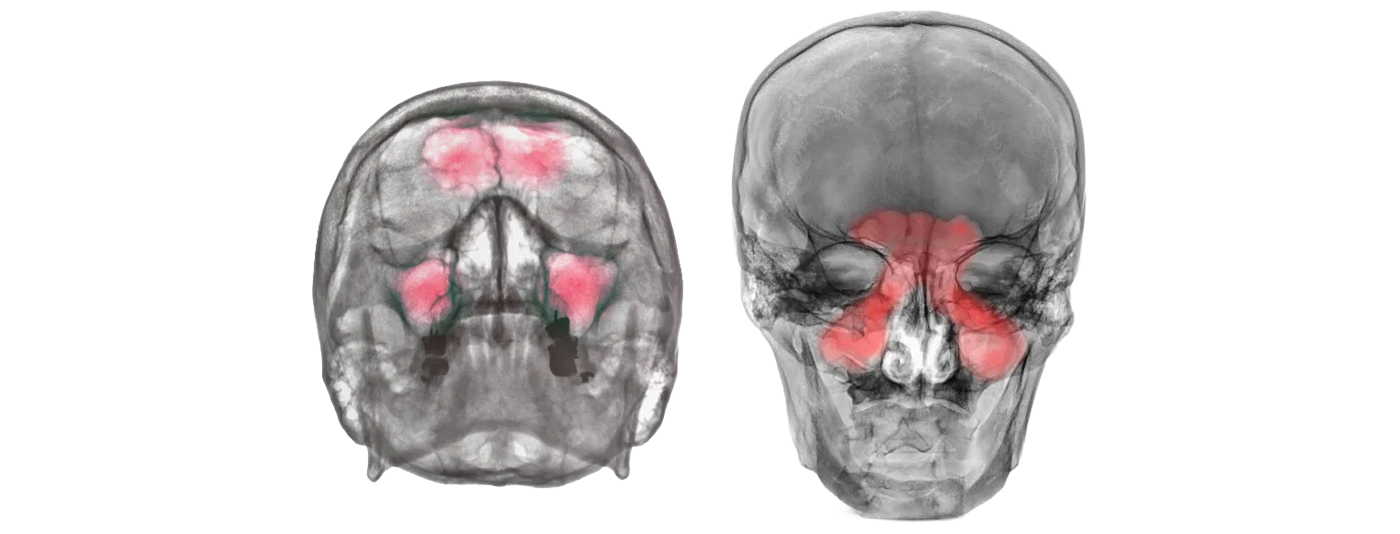 Рентген пазух носа